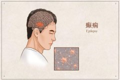 預(yù)防癲癇發(fā)作的護(hù)理措施